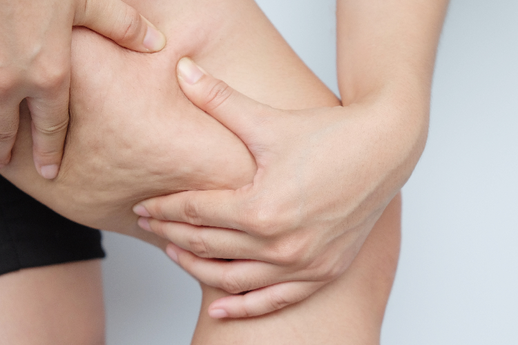 ふともものセルライト