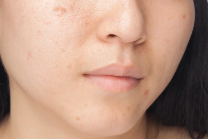 繰り返しできる大人ニキビを解消する方法6つ