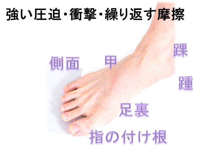 足の圧迫、衝撃、摩擦のイメージ