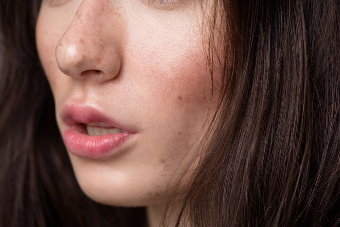 最近お肌が脂っぽい。毛穴の開きと、男性ホルモン増加の関係性とは