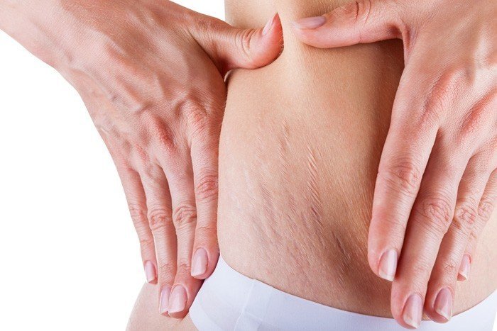 セルライトができている女性のお腹のイメージ