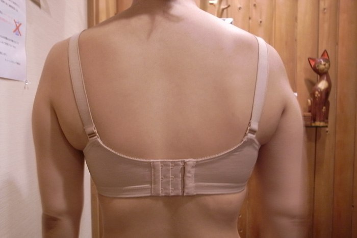 「二の腕シェイプ」を受ける前の女性の画像
