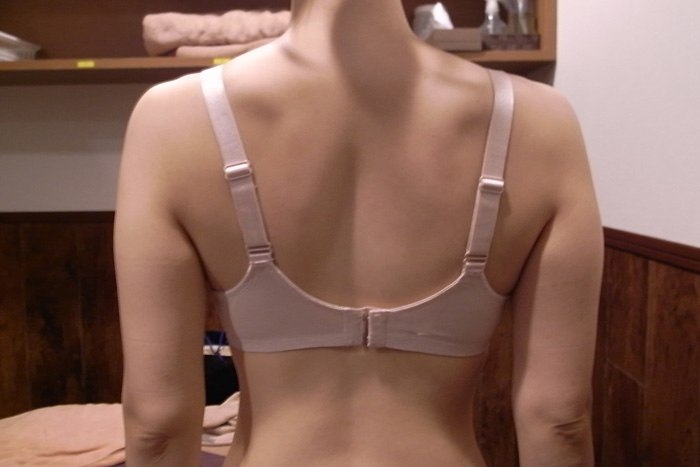 「二の腕シェイプ」を10回受けた後の女性の画像
