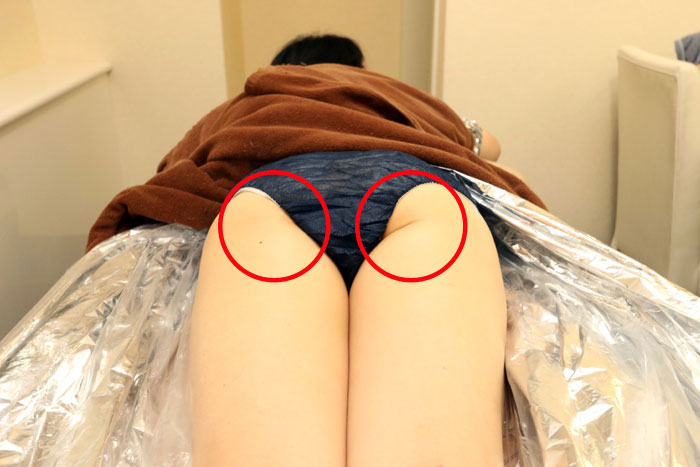 モンテセラピーの施術を受けて左のお尻のたるみが消えている様子