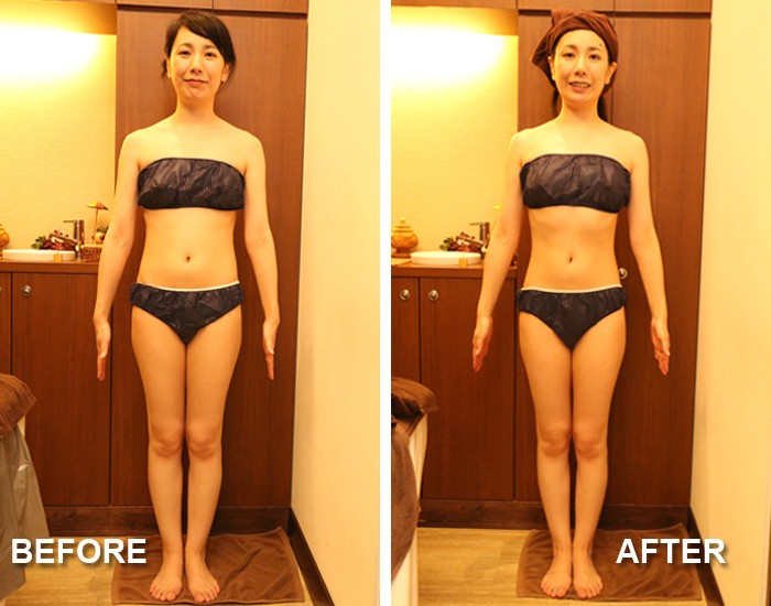 『深部リンパ節開放フラッシュセルバーンコース』正面のBEFORE・AFTER